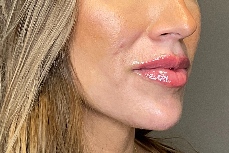 Chin Before & After Gallery - Patient 150478 - Image 4