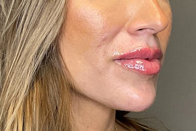 Chin Before & After Gallery - Patient 150478 - Image 4