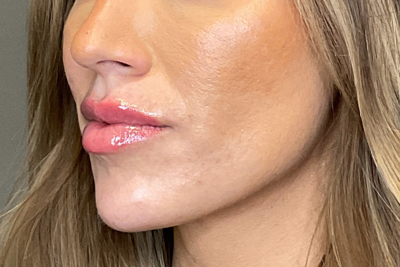 Lip Fillers Before & After Gallery - Patient 314306 - Image 8