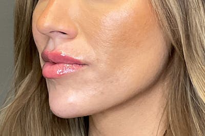 Lip Fillers Before & After Gallery - Patient 314306 - Image 8