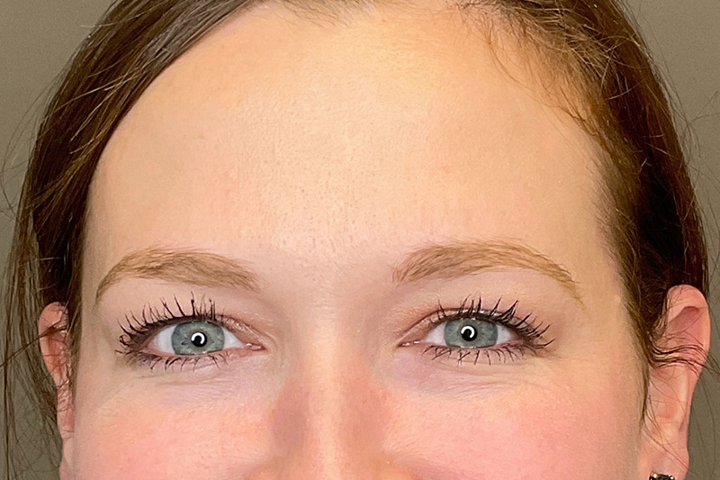 BOTOX Before & After Gallery - Patient 355411 - Image 4