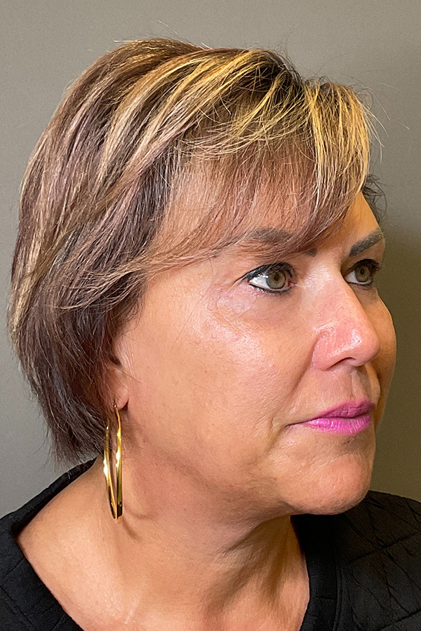 Laser Skin Resufacing Before & After Gallery - Patient 373414 - Image 3