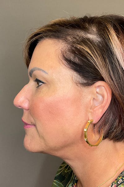 Laser Skin Resufacing Before & After Gallery - Patient 373414 - Image 10