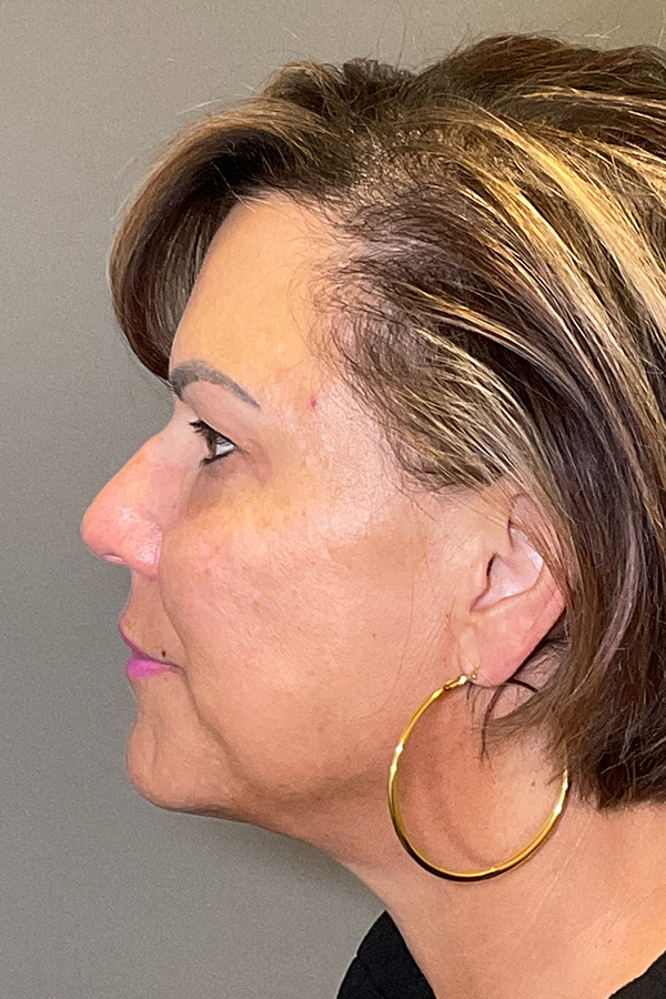 Laser Skin Resufacing Before & After Gallery - Patient 373414 - Image 9