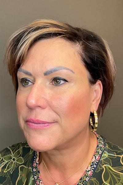Laser Skin Resufacing Before & After Gallery - Patient 373414 - Image 8
