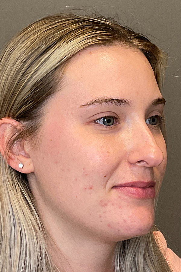 Acne Bootcamp Before & After Gallery - Patient 354040 - Image 3