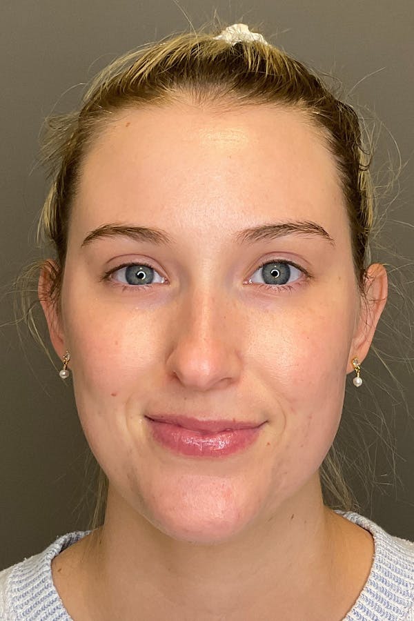 Acne Bootcamp Before & After Gallery - Patient 354040 - Image 2