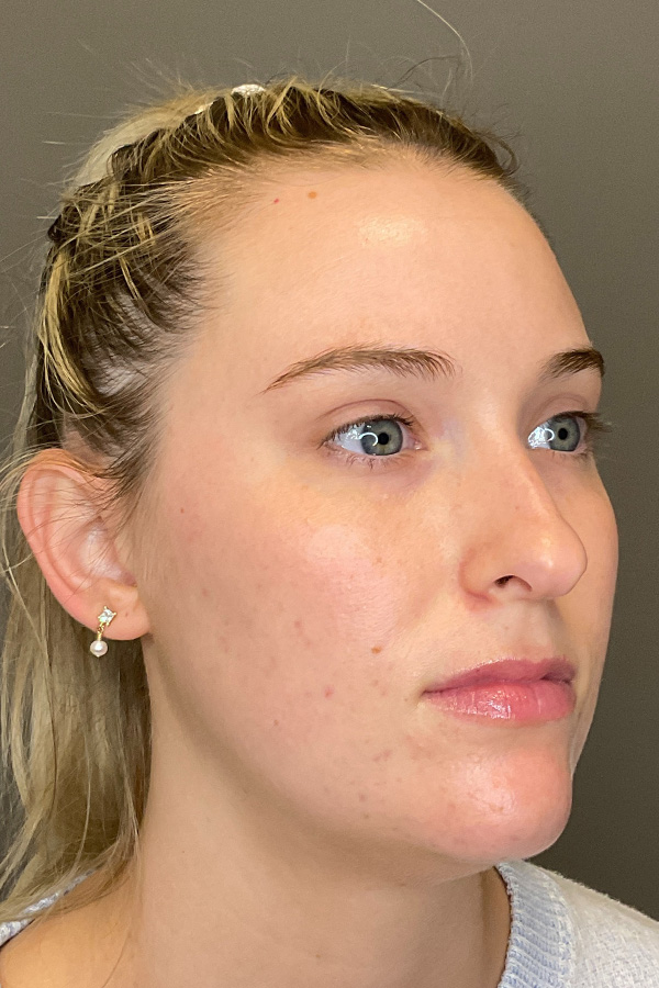 Acne Bootcamp Before & After Gallery - Patient 354040 - Image 4