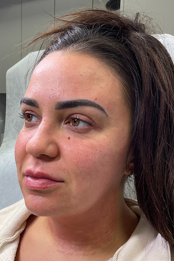 Morpheus8 Before & After Gallery - Patient 622282 - Image 5