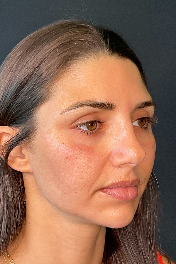 Laser Skin Resufacing Before & After Gallery - Patient 741435 - Image 3
