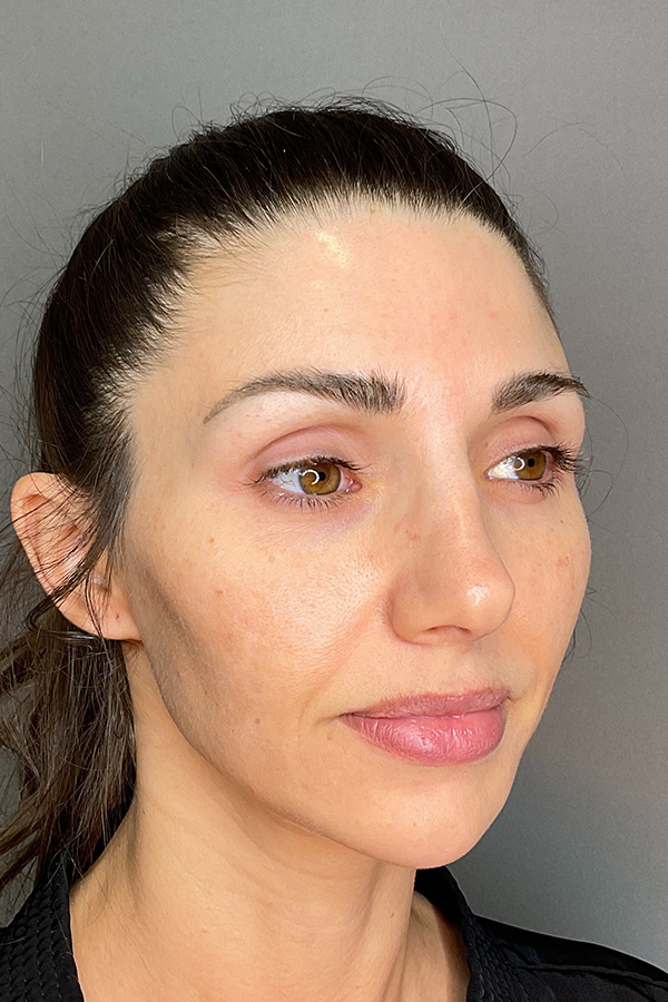 Laser Skin Resufacing Before & After Gallery - Patient 741435 - Image 4