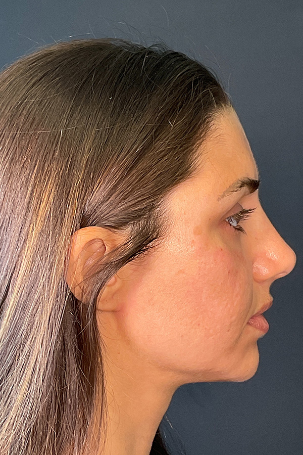Laser Skin Resufacing Before & After Gallery - Patient 741435 - Image 5