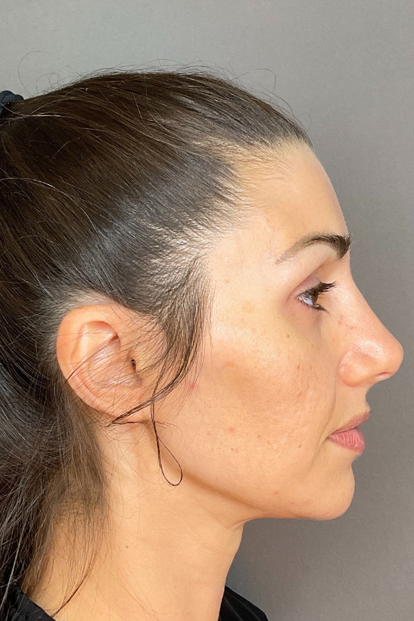 Laser Skin Resufacing Before & After Gallery - Patient 741435 - Image 6