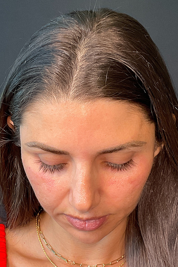 Laser Skin Resufacing Before & After Gallery - Patient 741435 - Image 7