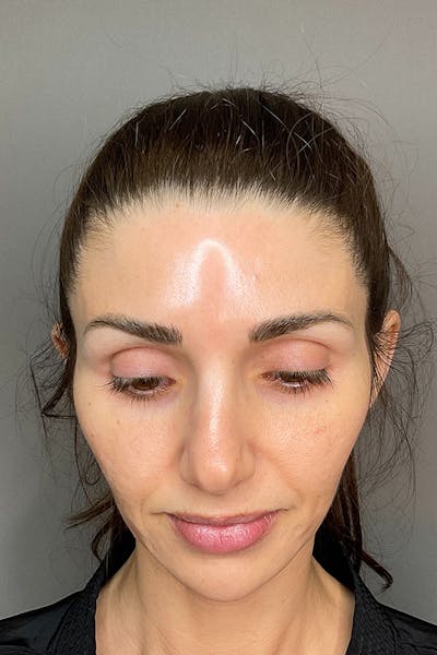 Laser Skin Resufacing Before & After Gallery - Patient 741435 - Image 8