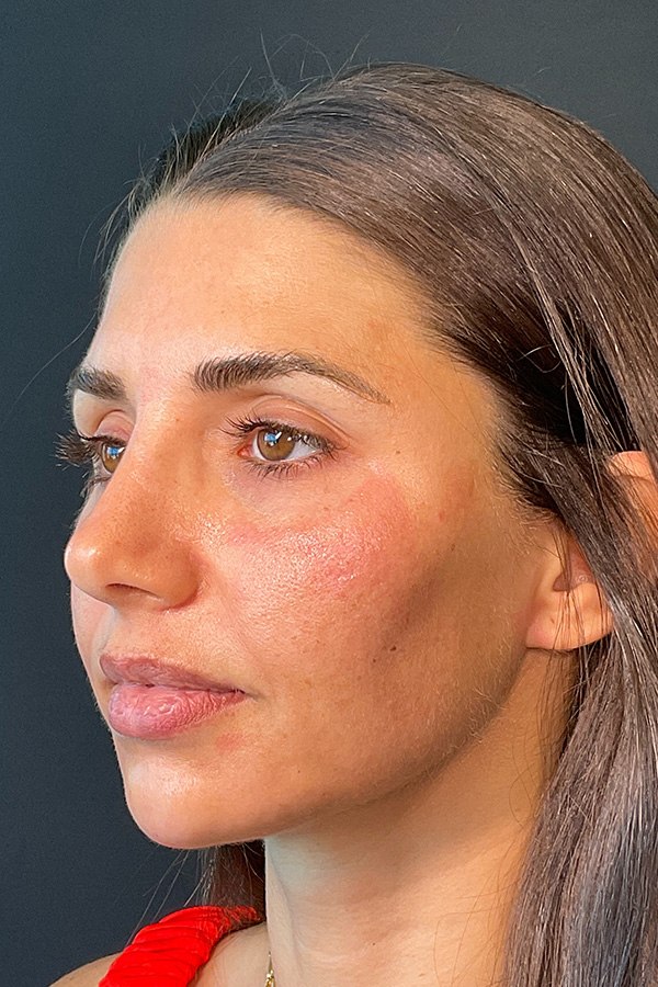 Laser Skin Resufacing Before & After Gallery - Patient 741435 - Image 9