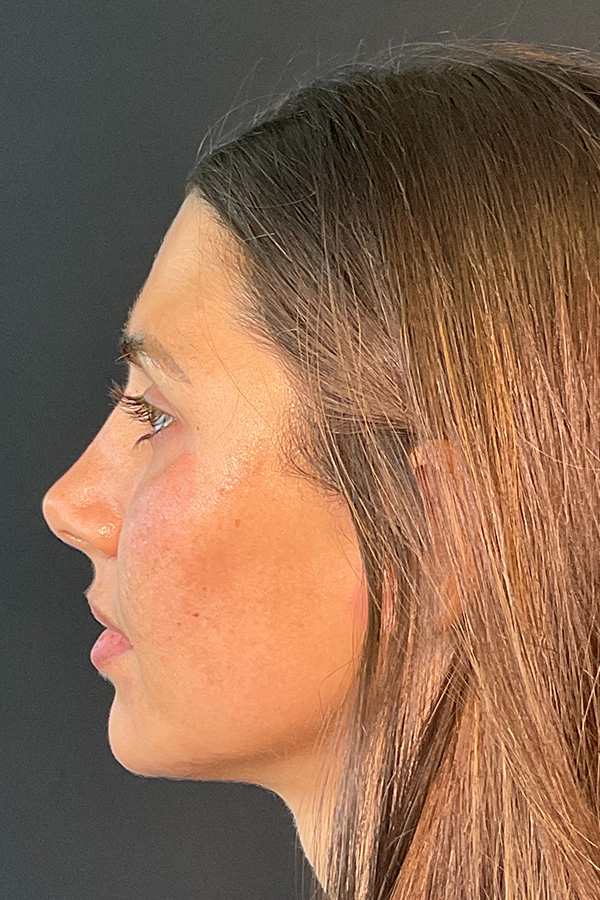 Laser Skin Resufacing Before & After Gallery - Patient 741435 - Image 11