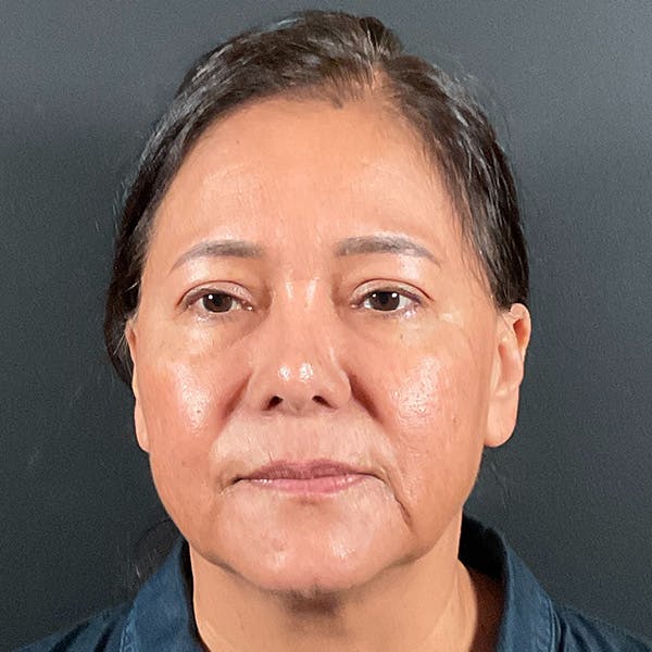 Blepharoplasty (Eyelid Surgery) Before & After Gallery - Patient 163465 - Image 2