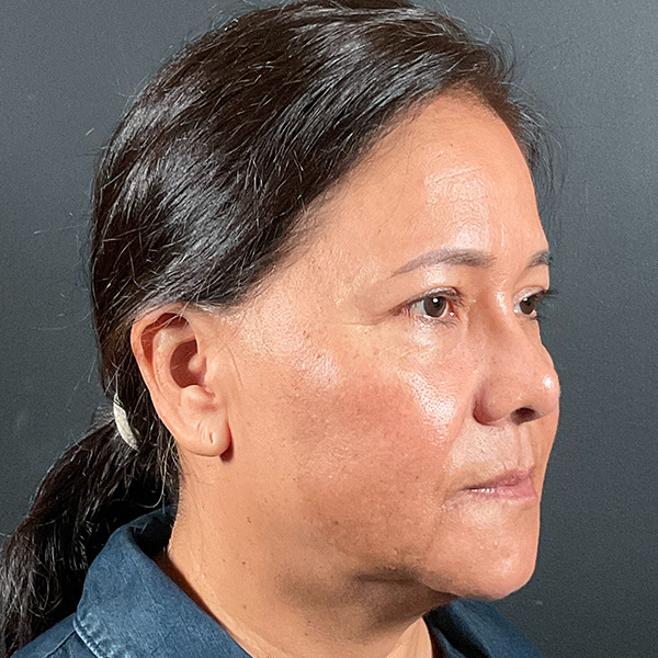 Blepharoplasty (Eyelid Surgery) Before & After Gallery - Patient 163465 - Image 4