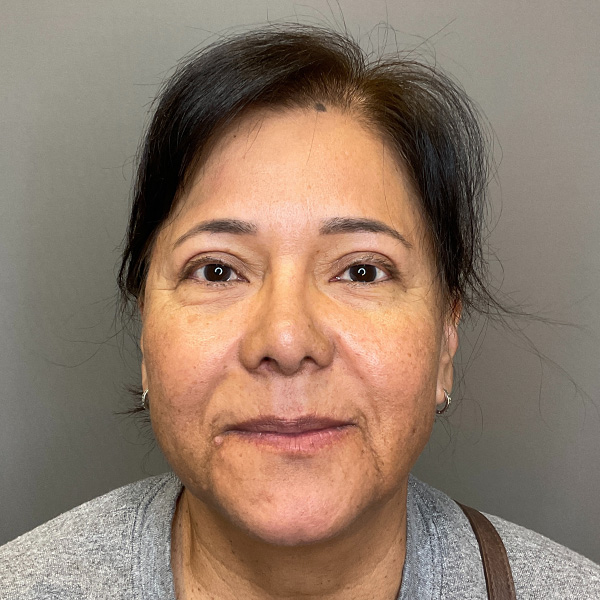 Blepharoplasty (Eyelid Surgery) Before & After Gallery - Patient 163465 - Image 1