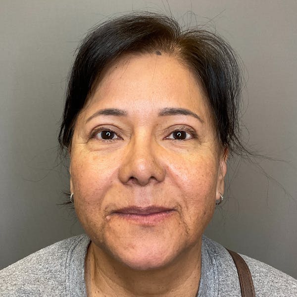 Blepharoplasty (Eyelid Surgery) Before & After Gallery - Patient 163465 - Image 1