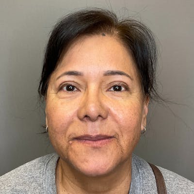 Blepharoplasty (Eyelid Surgery) Before & After Gallery - Patient 163465 - Image 1