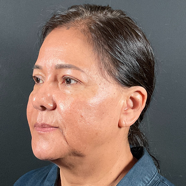 Blepharoplasty (Eyelid Surgery) Before & After Gallery - Patient 163465 - Image 8
