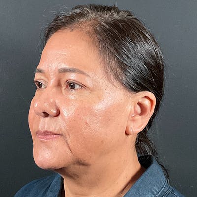 Blepharoplasty (Eyelid Surgery) Before & After Gallery - Patient 163465 - Image 8