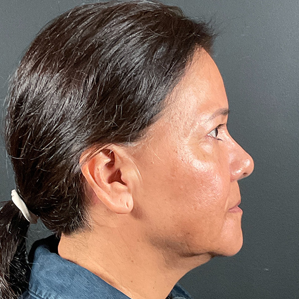 Blepharoplasty (Eyelid Surgery) Before & After Gallery - Patient 163465 - Image 6