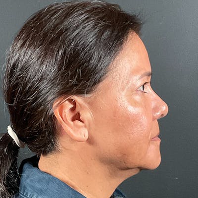 Blepharoplasty (Eyelid Surgery) Before & After Gallery - Patient 163465 - Image 6