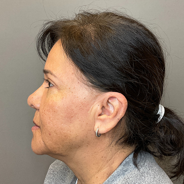 Blepharoplasty (Eyelid Surgery) Before & After Gallery - Patient 163465 - Image 9