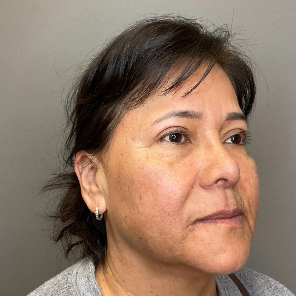 Blepharoplasty (Eyelid Surgery) Before & After Gallery - Patient 163465 - Image 3