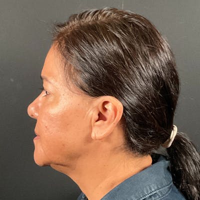 Blepharoplasty (Eyelid Surgery) Before & After Gallery - Patient 163465 - Image 10