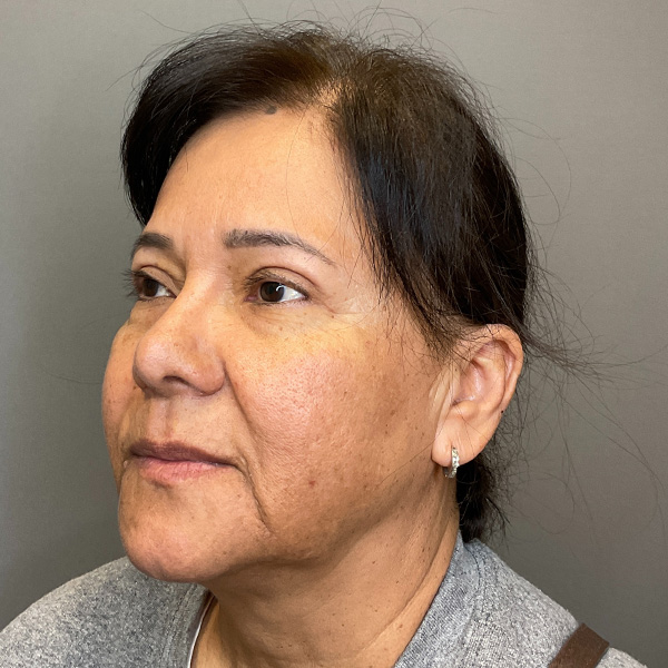 Blepharoplasty (Eyelid Surgery) Before & After Gallery - Patient 163465 - Image 7