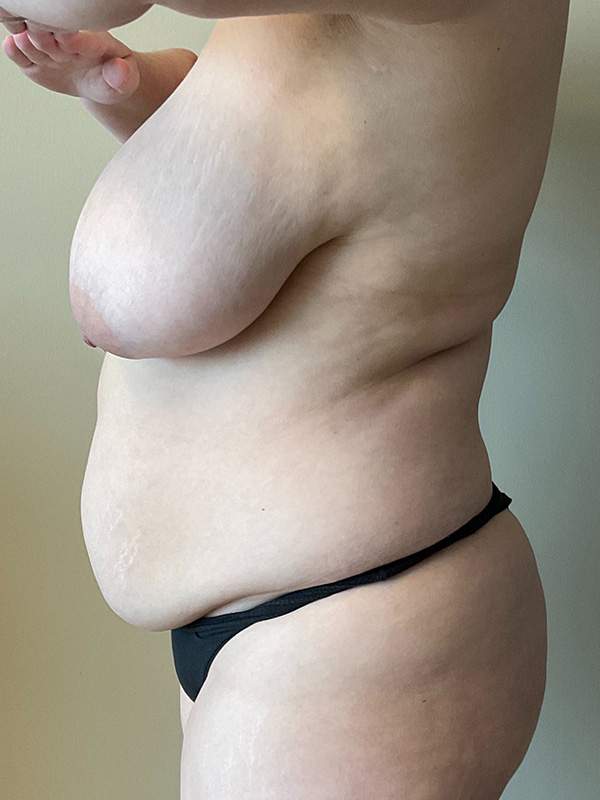 Mommy Makeover Before & After Gallery - Patient 337959 - Image 9