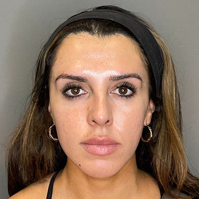 Non-Surgical Rhinoplasty Before & After Gallery - Patient 117387 - Image 1