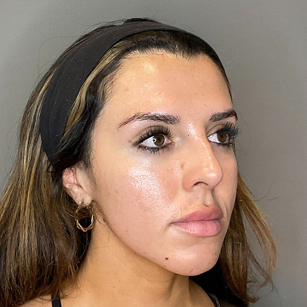 Non-Surgical Rhinoplasty Before & After Gallery - Patient 117387 - Image 3