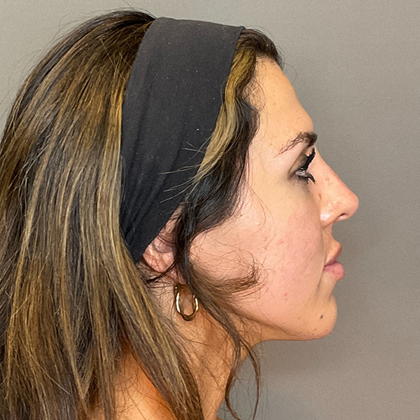 Non-Surgical Rhinoplasty Before & After Gallery - Patient 117387 - Image 6
