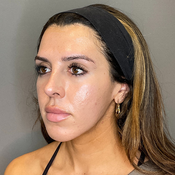 Non-Surgical Rhinoplasty Before & After Gallery - Patient 117387 - Image 7