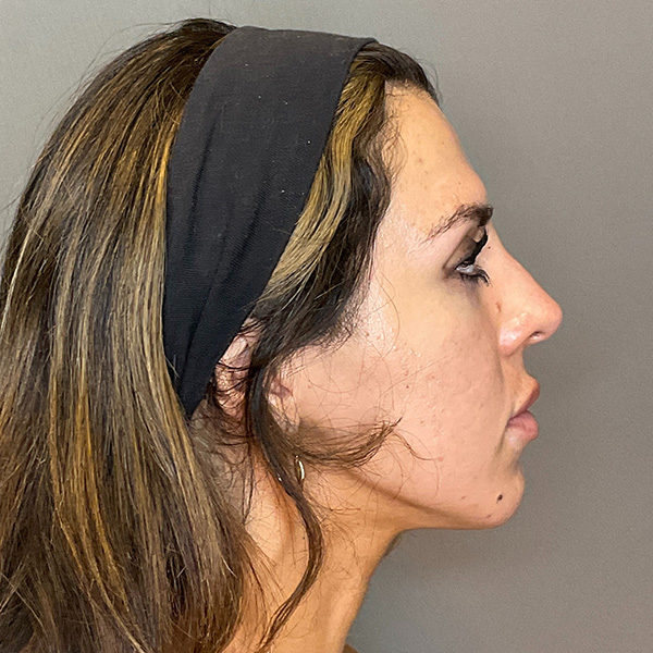 Non-Surgical Rhinoplasty Before & After Gallery - Patient 117387 - Image 5