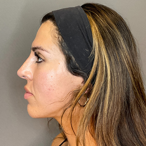 Non-Surgical Rhinoplasty Before & After Gallery - Patient 117387 - Image 10
