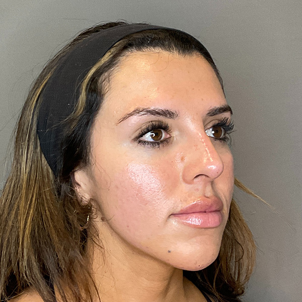 Non-Surgical Rhinoplasty Before & After Gallery - Patient 117387 - Image 4