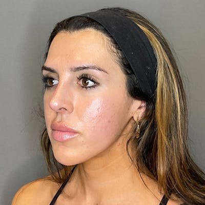 Non-Surgical Rhinoplasty Before & After Gallery - Patient 117387 - Image 8