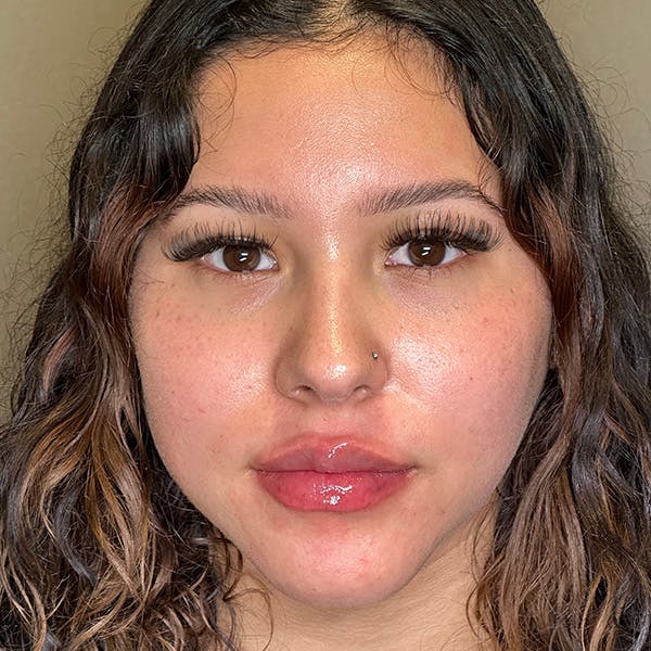 Lip Fillers Before & After Gallery - Patient 151440 - Image 2