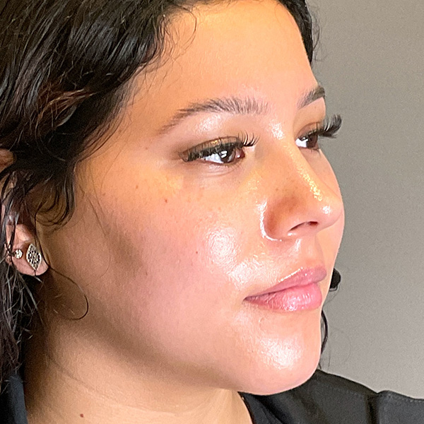 Lip Fillers Before & After Gallery - Patient 151440 - Image 3
