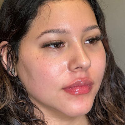 Lip Fillers Before & After Gallery - Patient 151440 - Image 4