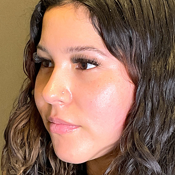 Lip Fillers Before & After Gallery - Patient 151440 - Image 5