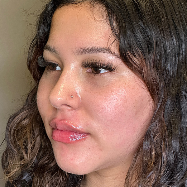 Lip Fillers Before & After Gallery - Patient 151440 - Image 6
