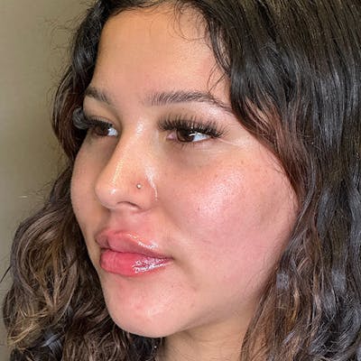 Lip Fillers Before & After Gallery - Patient 151440 - Image 6