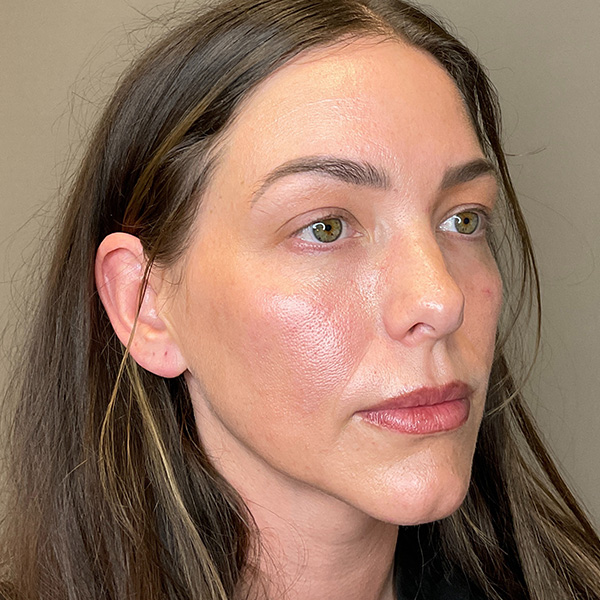 PRF EZ Gel Before & After Gallery - Patient 101880 - Image 3